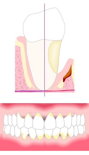Efermedad Periodontal Moderada